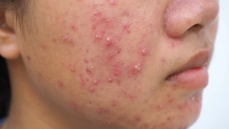 Acne services