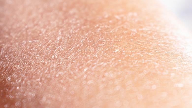 Dry Skin (Xerosis)