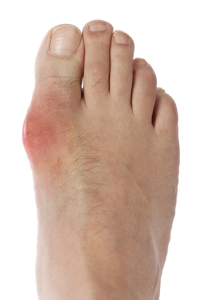 Gout