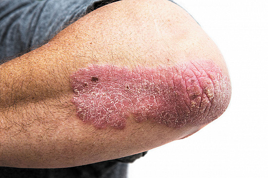Psoriasis services